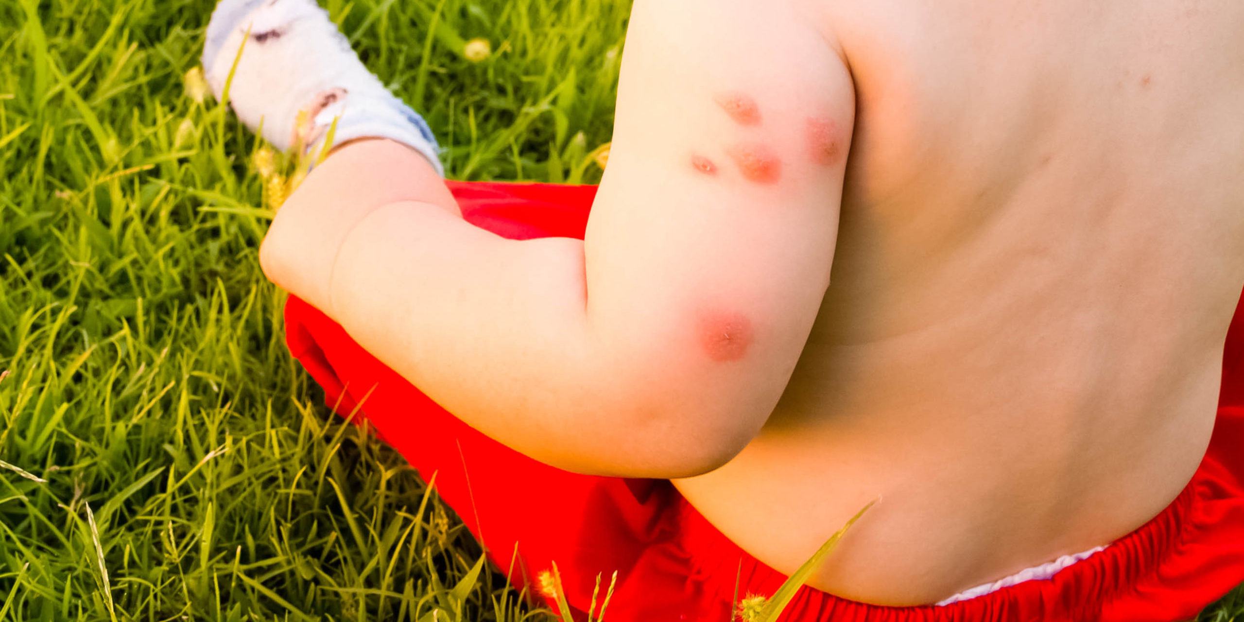 New,Born,With,Multiple,Mosquito,Bites,Allergy,To,Insect,Bites